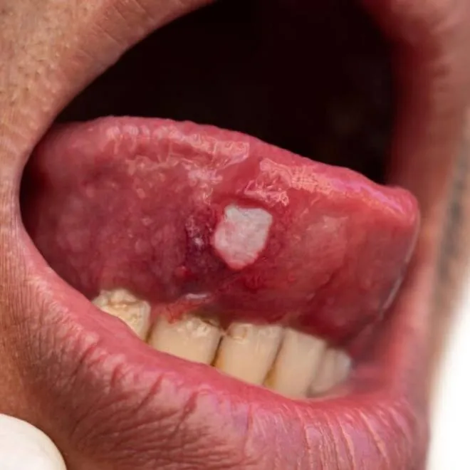 Ağız Kanseri Nedir? Tükürük Testinden Yapay Zekâya Son Gelişmeler