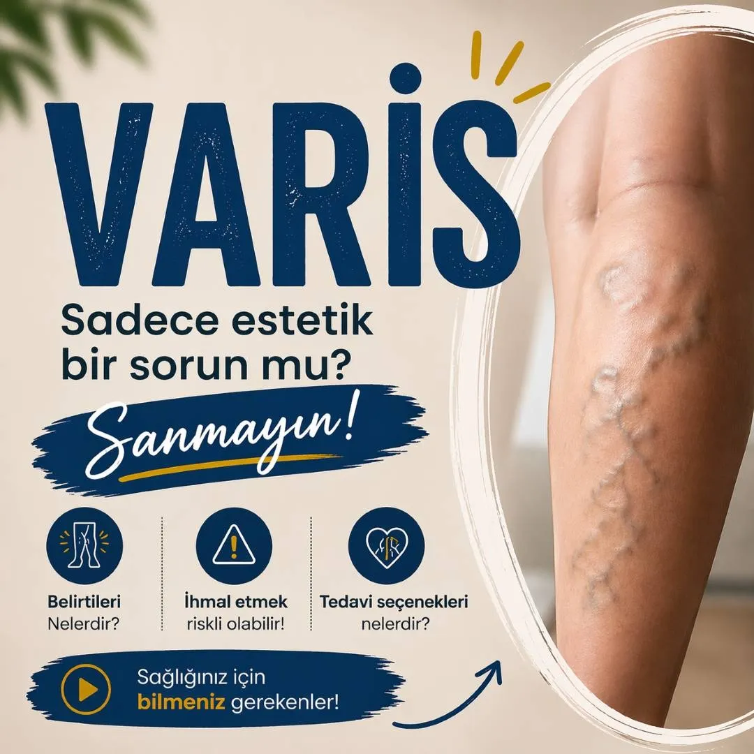 Varis  Nedir? Kronik Venöz Yetmezlik - Damarın İçinde Neler Oluyor?
